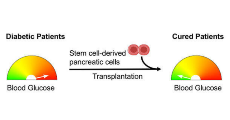 Stem Cell Therapy for Diabetes in India: A Promising Frontier