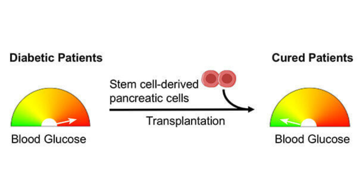 Diabetes Stem Cell Therapy India